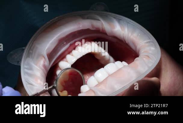 Dental mirror open mouth Stock Videos & Footage - HD and 4K Video Clips ...