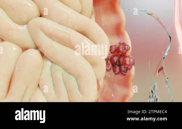 Bowel cancer or Colorectal tumor, Colon cancer, intestine inflammatory ...