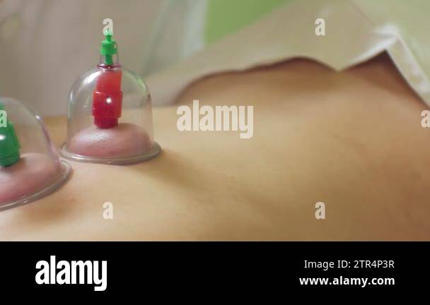 Traditional Chinese Medicine Cupping process. Hijamah Cups on back of ...