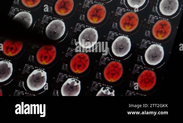 4k Doctors study head pet-ct skull brain scan X-ray film for analysis ...