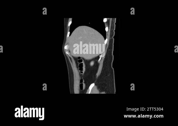 ct scan of abdomen side view smooth motion Stock Video Footage - Alamy