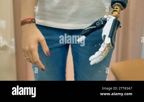 Robotic prosthesis arm connected to a disabled woman hand. 4K Stock ...