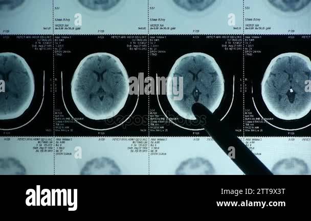China-Sep 08,2016:doctor study head pet/ct scan for analysis the ...