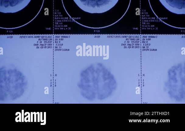 China-Sep 08,2017:moving head pet cT scan,skull brain X-ray Stock Video ...