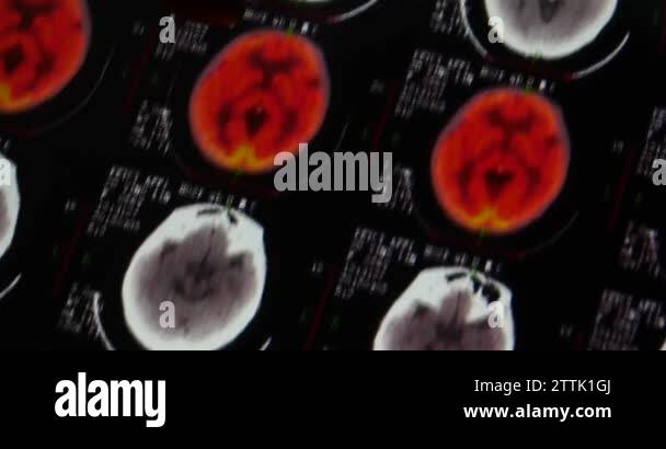 4k Doctors study head PET-ct skull brain scan X-ray film for analysis ...