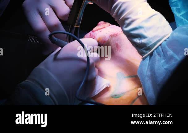 The introduction of the implant into the patients chest during plastic ...