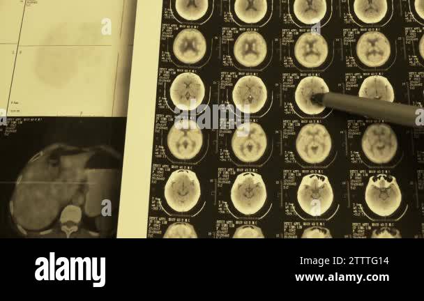 doctor study color head & vertebral pet-ct,skull brain X-ray Stock ...