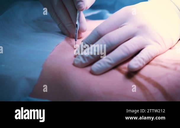 The introduction of the implant into the patients chest during plastic ...