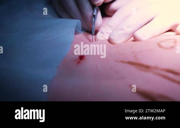 The introduction of the implant into the patients chest during plastic ...
