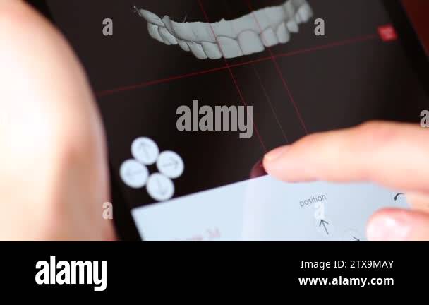 Digital technology. CAD CAM system. Teeth before and after prosthetics ...