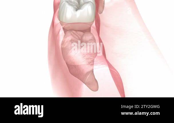 Vertical, Horizontal and Distal impaction of Wisdom tooth. Medically ...
