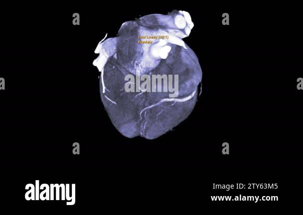 CTA Coronary artery short axis plane on the screen for diagnosis ...