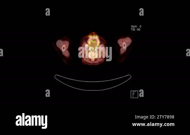 PET CT Scan of whole body from head to toe with fusion technique mix CT ...
