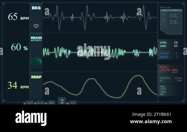 Normal ecg electrocardiogram wave Stock Videos & Footage - HD and 4K ...