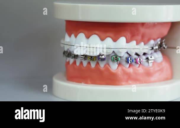 Dentistry bite model brace Stock Videos & Footage - HD and 4K Video ...