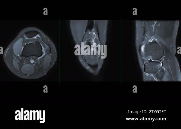 Compare of MRI knee or Magnetic resonance imaging of knee joint stir ...