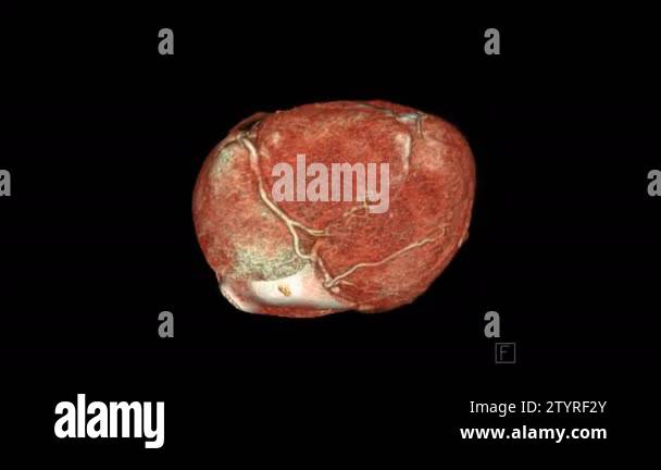 CTA Coronary artery 3D rendering image turn around on the screen for ...