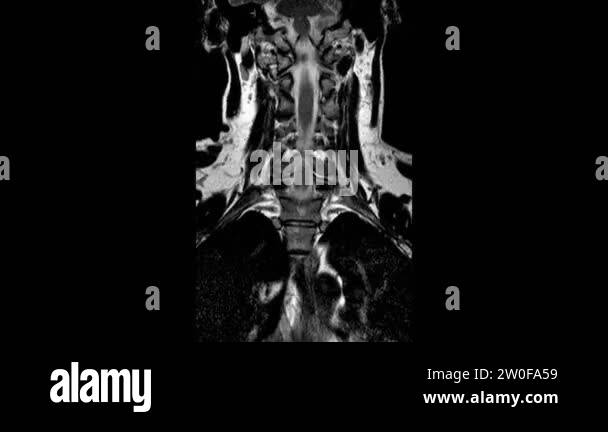 Mri of the cervical spine Stock Videos & Footage - HD and 4K Video ...