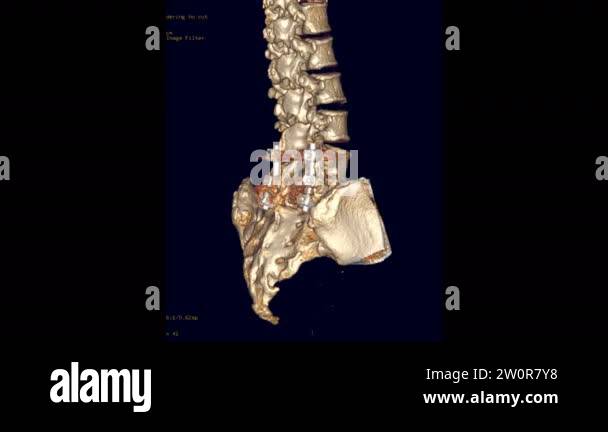 CT Lumbar spine or L-S spine 3D rendering image turn around on the ...