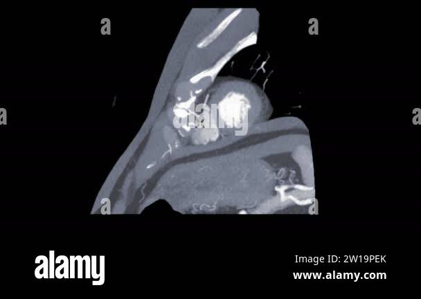 CTA Coronary artery short axis plane on the screen for diagnosis ...