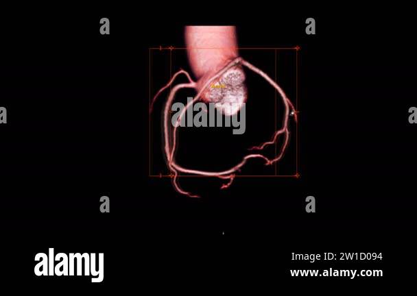 CTA Coronary artery short axis plane on the screen for diagnosis ...