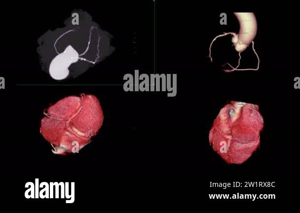 CTA Coronary artery short axis plane on the screen for diagnosis ...