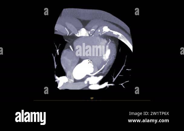 CTA Coronary artery short axis plane on the screen for diagnosis ...