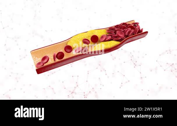 Blood cells with plaque buildup of cholesterol isolated white Stock ...