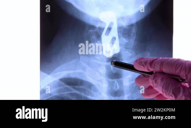 X ray of the neck of cervical vertebrae Stock Videos & Footage - HD and ...