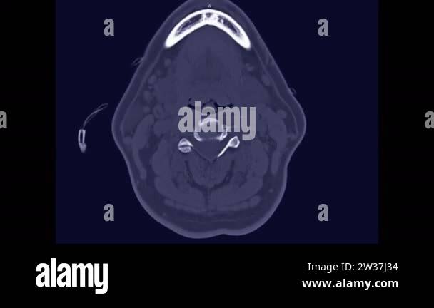 Cervical spine Stock Videos & Footage - HD and 4K Video Clips - Alamy