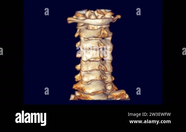 Ct spine cervical 3d rendering Stock Videos & Footage - HD and 4K Video ...