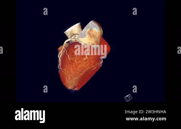 CTA Coronary Artery 3D rendering image showing heart and vessel ...
