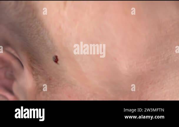 3D animation of Black birthmark on the skin surface.( head and neck ...