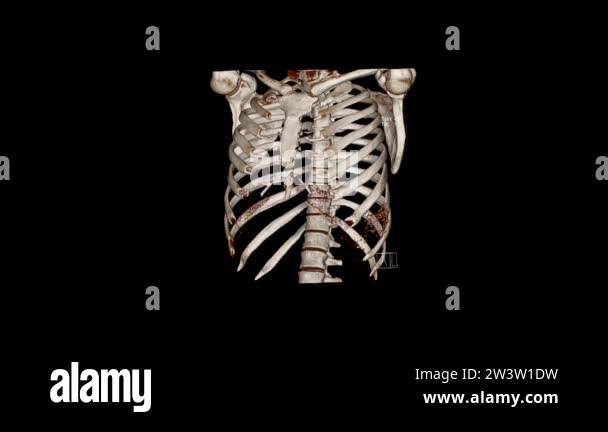 Computed Tomography Volume Rendering examination of the thoracic cage ...