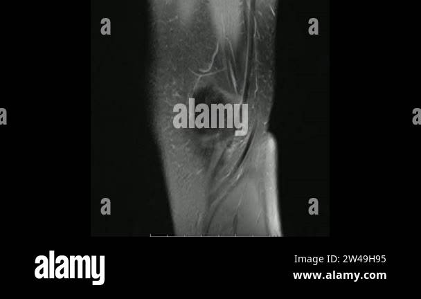 Magnetic Resonance images of The Knee joint Sagittal Proton density ...