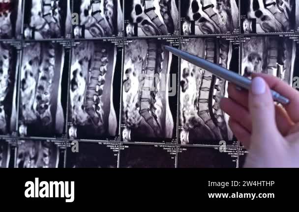Spinal lumbar stenosis x ray Stock Videos & Footage - HD and 4K Video ...