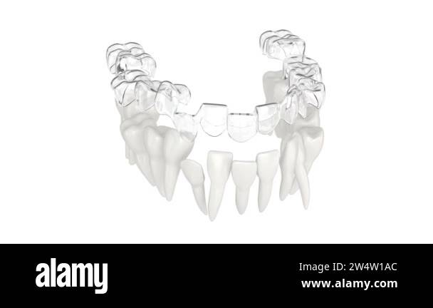 Teeth splint Stock Videos & Footage - HD and 4K Video Clips - Alamy