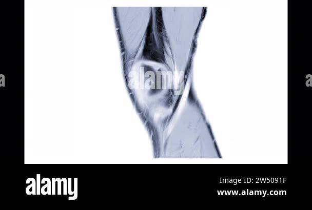 MRI knee or Magnetic resonance imaging of knee joint sagittal for ...