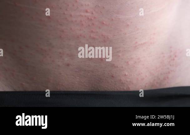 Rash on the skin of a man in the groin area, the concept of venereal ...