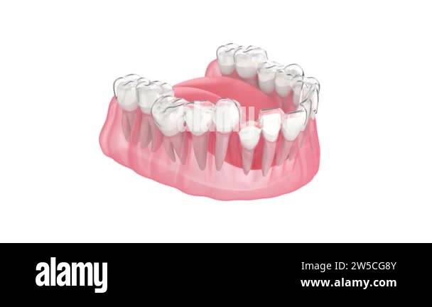 Invisalign aligner Stock Videos & Footage - HD and 4K Video Clips - Alamy