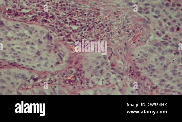 Squamous Cell Microscope squamous cell carcinoma, lung tissue under the microscope 200x Stock ...