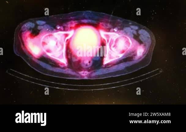 SPECT CT of the Pelvis Showing Bony Anatomy Stock Video Footage - Alamy