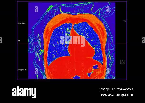 Color Ct Image CT Chest with contrast media Coronal view with fusion color for lung ...