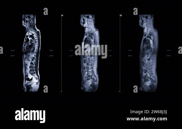 Mri of thoracic spinal cord Stock Videos & Footage - HD and 4K Video ...