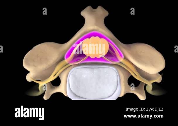 Ray spinal fracture Stock Videos & Footage - HD and 4K Video Clips - Alamy