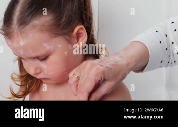sad little girl with chickenpox, antiseptic cream applied to the rash ...