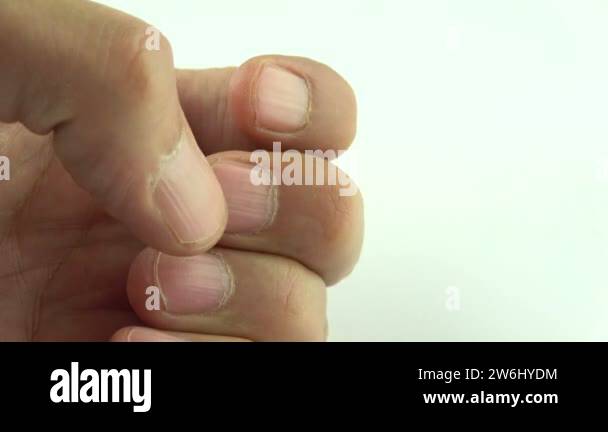 Vertical ridges on the fingernails symptoms deficiency vitamins and ...