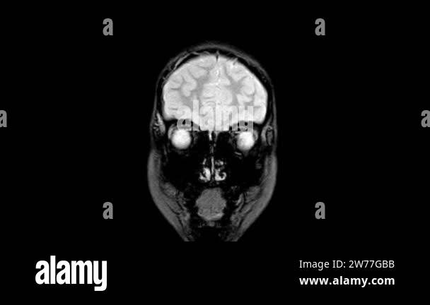 Closeup of a CT scan with brain. Medical, science and education mri ...