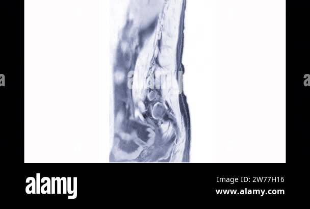 Lumbar spinal cord Stock Videos & Footage - HD and 4K Video Clips - Alamy