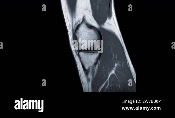 Mri Knee Or Magnetic Resonance Imaging Of Knee Joint Sagittal Pdw For 